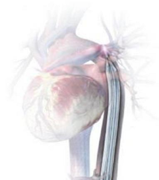 Hướng dẫn thực hiện quy trình kỹ thuật chuyên môn đặt bóng đối xung trong động mạch chủ
